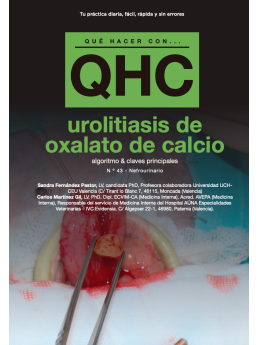 Qué Hacer Con... Urolitiasis de oxalato de calcio