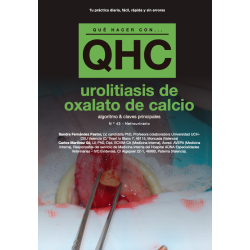 Qué Hacer Con... Urolitiasis de oxalato de calcio
