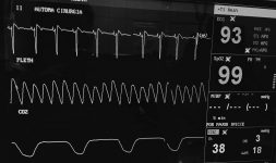 Alteraciones en el ECG antes de cirugía por obstrucción ureteral